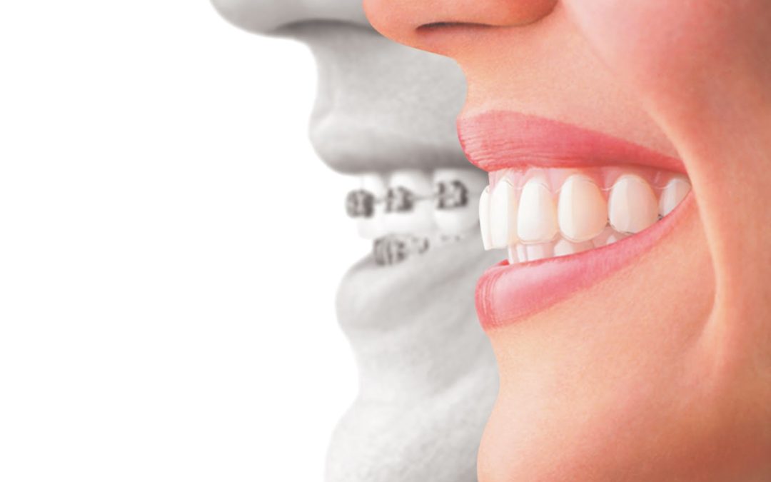 Ask Your Pleasanton Dentist: What’s the difference between Invisalign and Metal Braces?