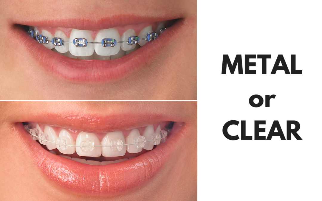 Ask Your Pleasanton Dentist: Should I Get Metal or Clear Braces?
