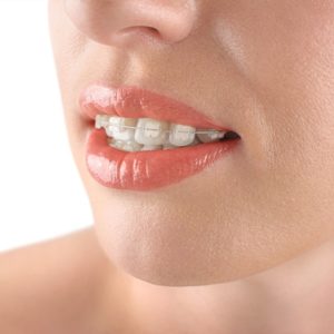 Republic Dental and Orthodontics Pleasanton services clear braces